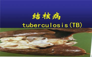 结核病防治工作半年总结5篇
