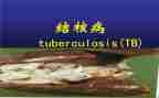 结核病防治工作半年总结5篇